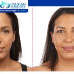 Forehead Reduction Without Surgery