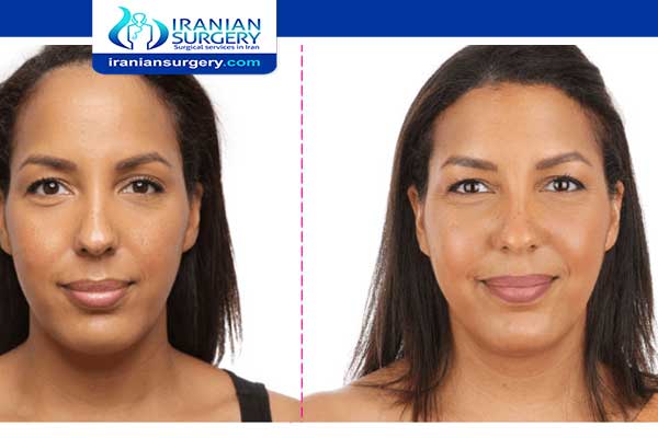 Forehead Reduction Without Surgery