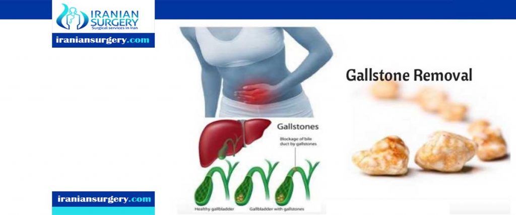 Gallstones Treatment in Iran