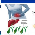 Gallstones Treatment in Iran