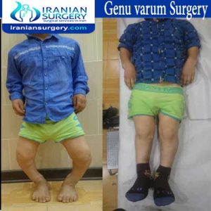 Genu-varum-surgery dr Jafari