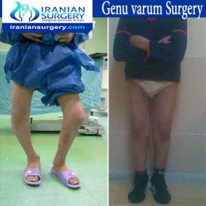 Genu-varum-surgery2 dr Jafari