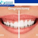 Gingivectomy in Iran