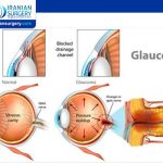 Glaucoma definition