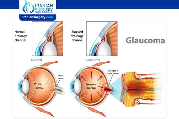 Glaucoma definition