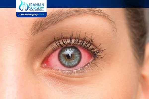 Glaucoma drugs | Which drug is used to cure glaucoma? | Iranian Surgery