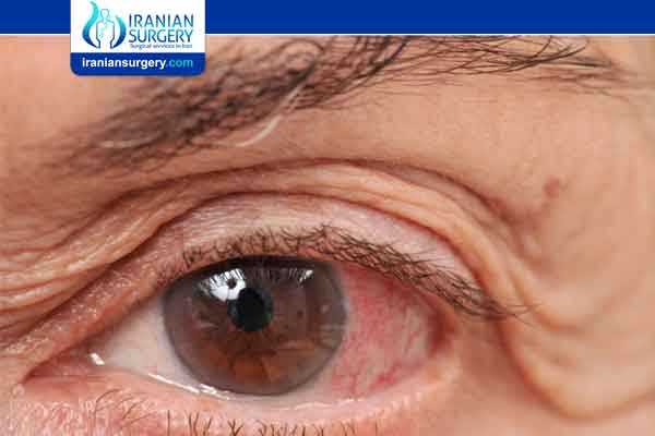 Glaucoma symptoms and causes
