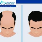 Hair transplant cost in Iran