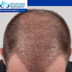 Hair transplant growth stages