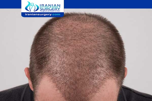 Hair Transplant Results After 2 Months | Before & After Images
