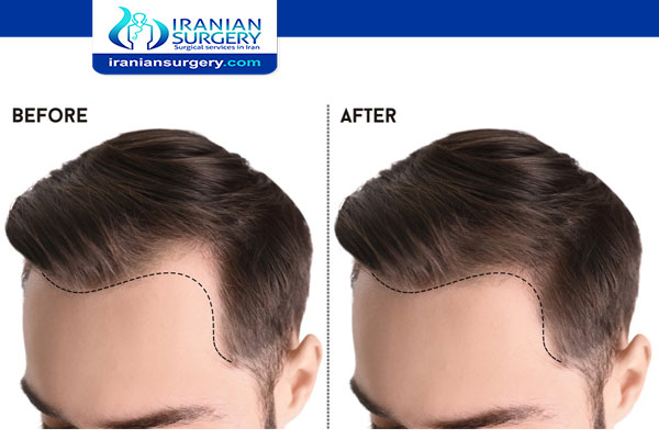 Hair transplant without shaving