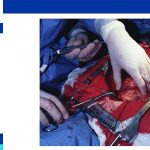 Heart bypass surgery procedure