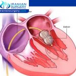 عملیة تصلیح صمام القلب