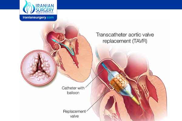 is tavr a major surgery