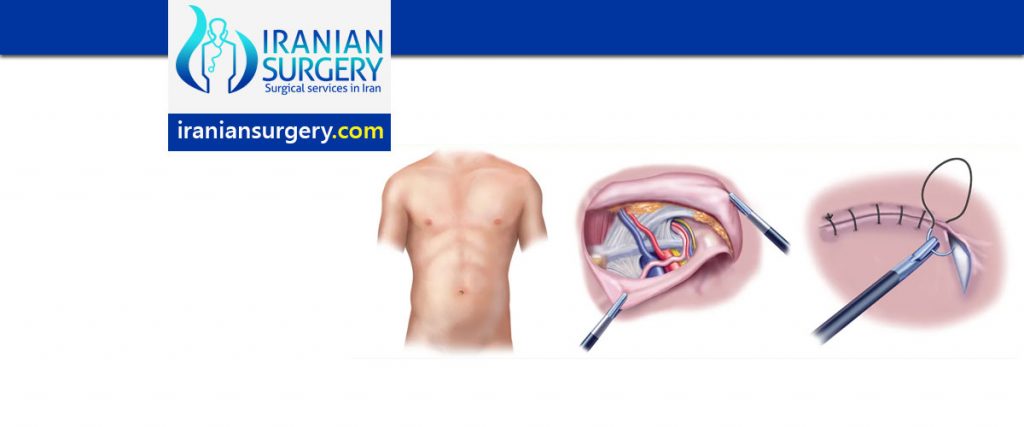 Hernia Repair Surgery in Iran