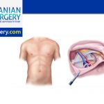 Hernia Repair Surgery in Iran