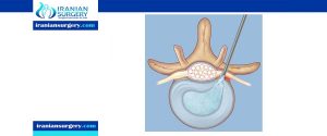 Herniated Disc Surgery