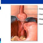 Hiatal Hernia Surgery