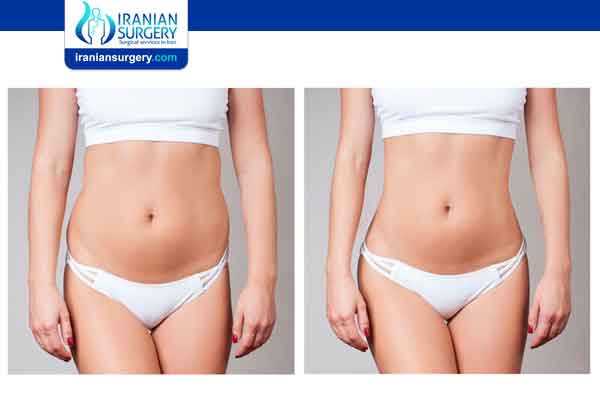 How dangerous is liposuction?