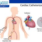 كم تستغرق عملية قسطرة القلب للاطفال؟