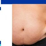 How much does abdominal liposuction cost in Iran