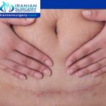 Hysterectomy surgery scars