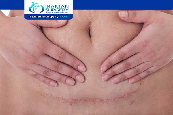 Hysterectomy surgery scars