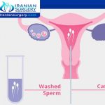 IUI treatment process