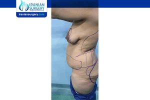 Ideal bmi for tummy tuck