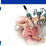 In laparoscopic prostatectomy