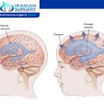 عملیة ترکیب صمام المخ