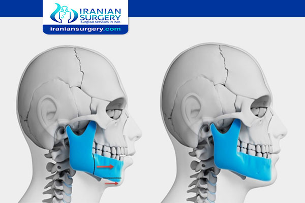 Jaw surgery in Iran