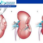 Kidney cancer treatment in Iran