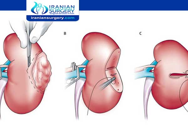 Kidney cancer treatment in Iran