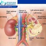 Kidney cancer treatment stages