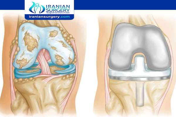 Knee replacement surgery cost