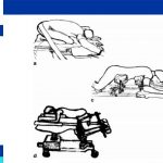 Laminectomy Surgery Position