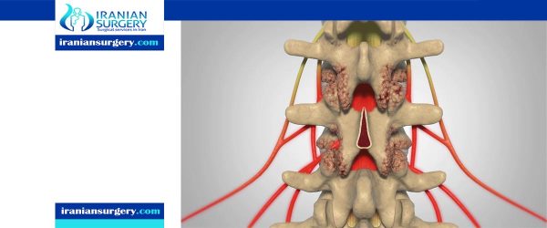 Laminectomy Recovery Time Laminectomy Back Surgery Recovery Time 3116