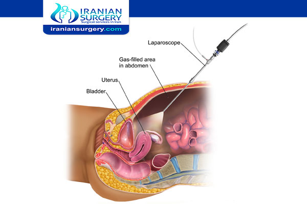 Laparoscopic diagnosis for infertility