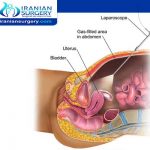 الجراحة بواسطة التنظير