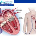 عملیة صمامات القلب باللیزر