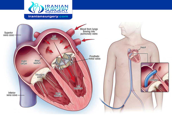عملیة صمامات القلب باللیزر