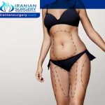 Laser lipo vs Coolsculpting