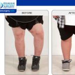 Leg Lengthening Surgery Recovery