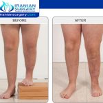 Leg lengthening surgery in Iran