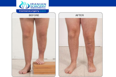 Leg lengthening surgery in Iran