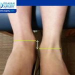 Limb Length Discrepancy Symptoms