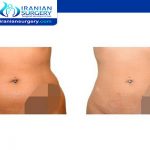 Lipomatic vs liposuction