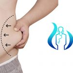 Liposuction Surgery