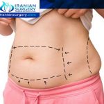 Liposuction cost